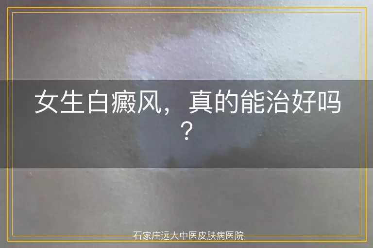 女生白癜风，真的能治好吗？