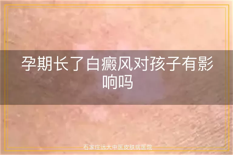 孕期长了白癜风对孩子有影响吗