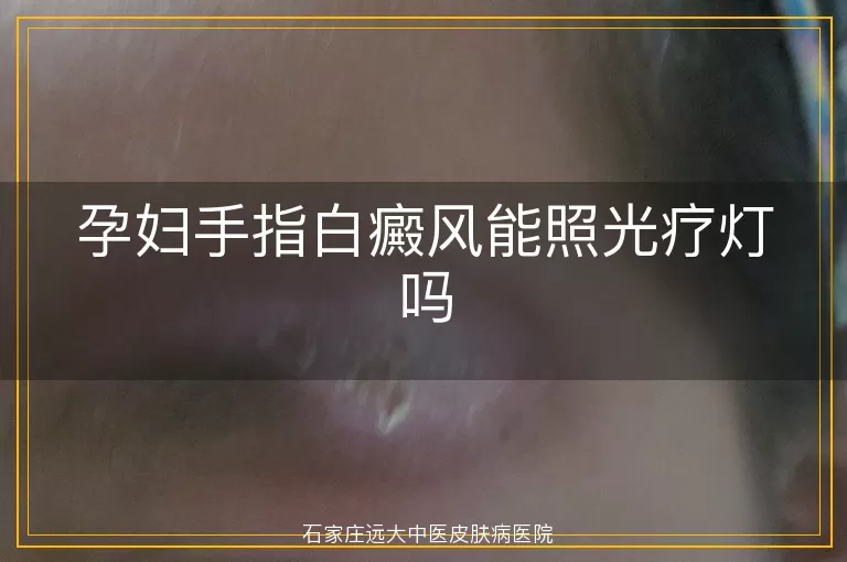 孕妇手指白癜风能照光疗灯吗