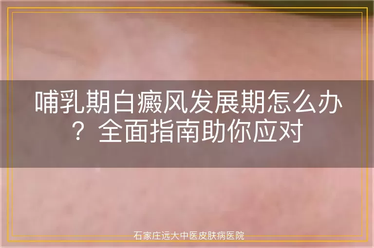 哺乳期白癜风发展期怎么办？全面指南助你应对