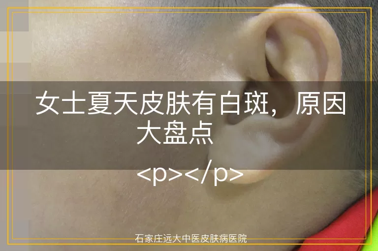 女士夏天皮肤有白斑，原因大盘点
<p></p>