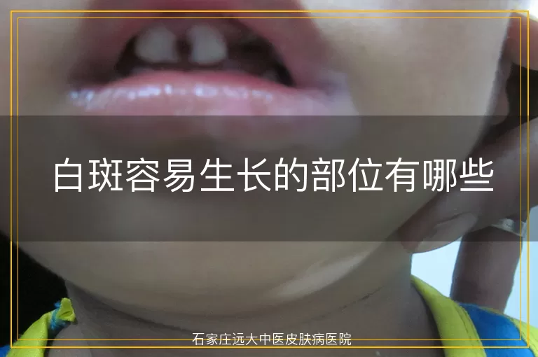 白斑容易生长的部位有哪些
