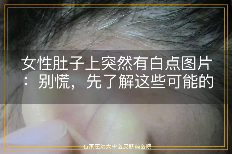 女性肚子上突然有白点图片：别慌，先了解这些可能的原因