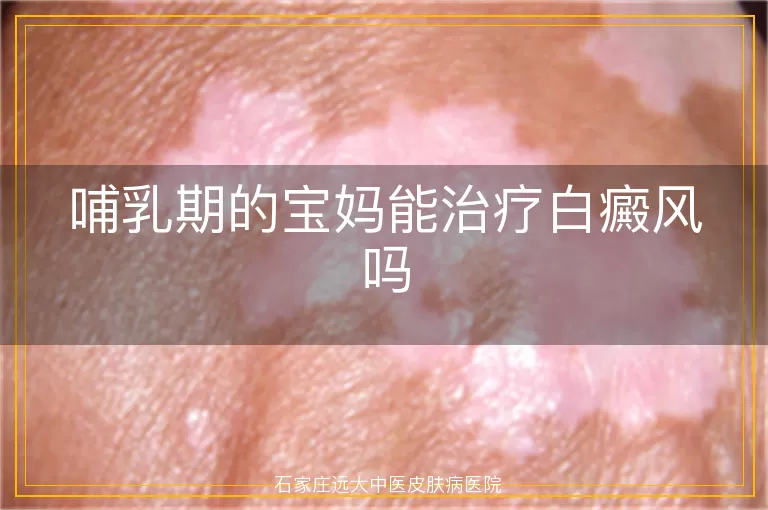 哺乳期的宝妈能治疗白癜风吗