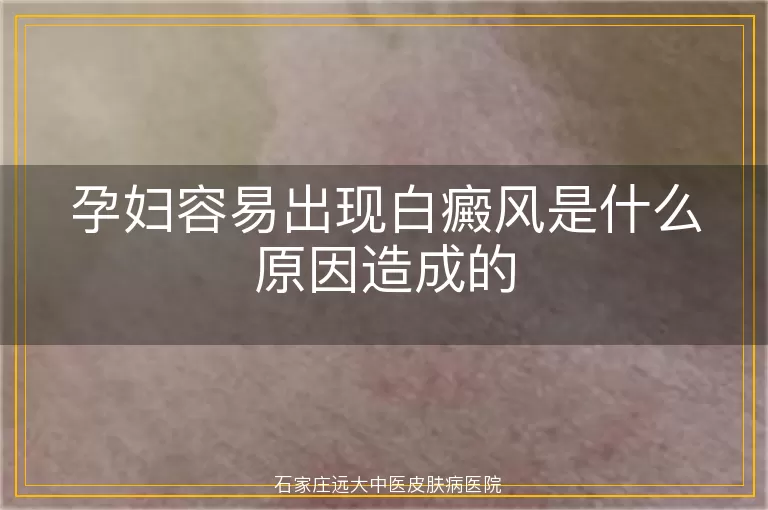 孕妇容易出现白癜风是什么原因造成的
