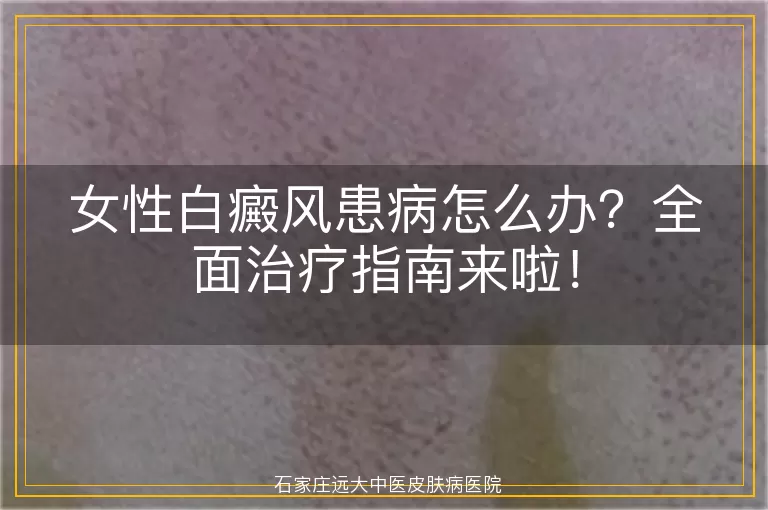 女性白癜风患病怎么办？全面治疗指南来啦！