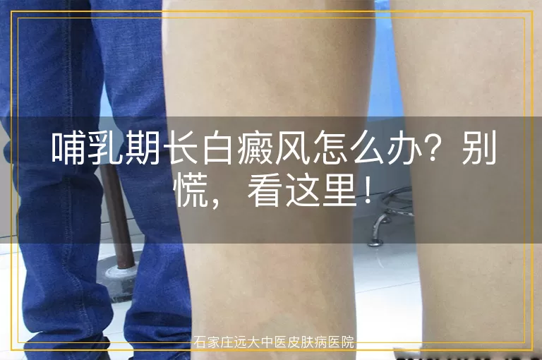 哺乳期长白癜风怎么办?别慌,看这里!