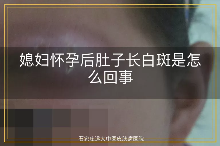 媳妇怀孕后肚子长白斑是怎么回事