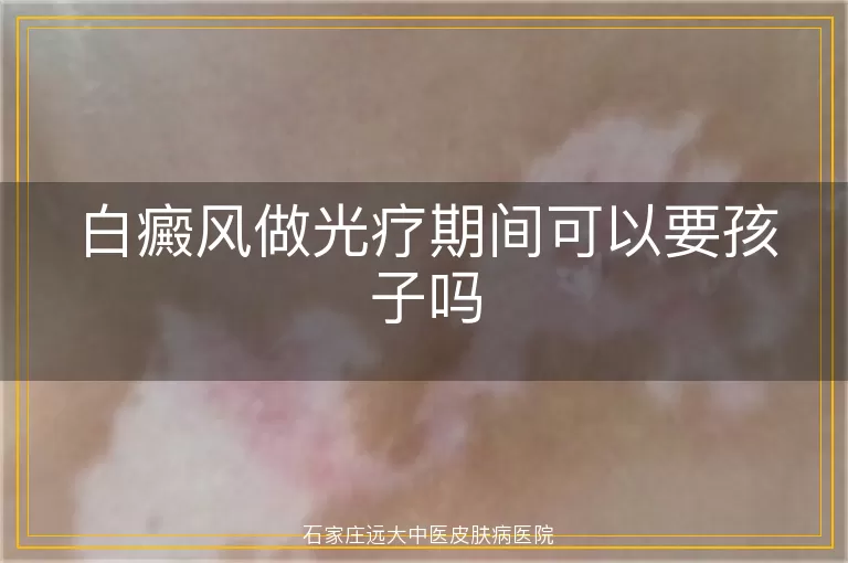 白癜风做光疗期间可以要孩子吗