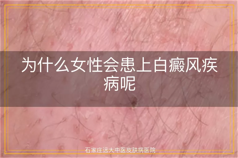 为什么女性会患上白癜风疾病呢