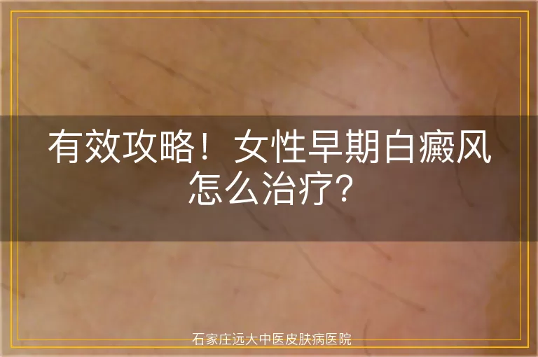 有效攻略！女性早期白癜风怎么治疗？