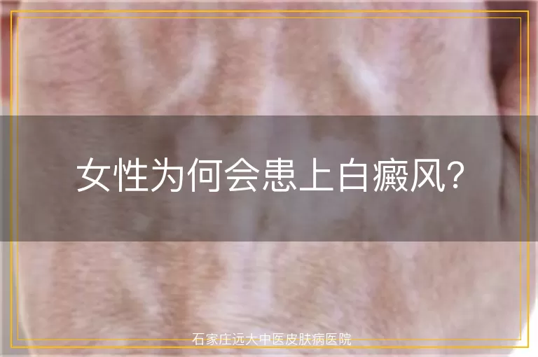 女性为何会患上白癜风？
