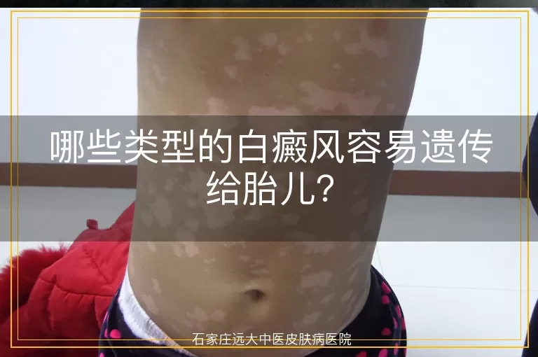 哪些类型的白癜风容易遗传给胎儿？