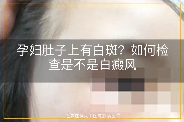 孕妇肚子上有白斑？如何检查是不是白癜风
