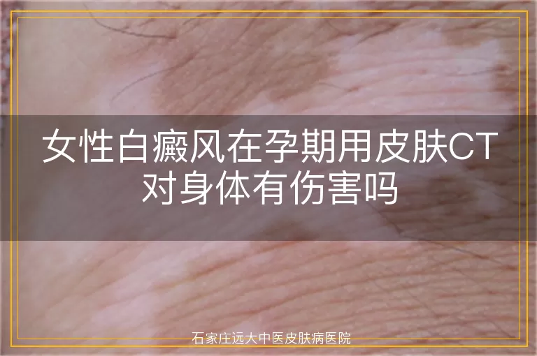 女性白癜风在孕期用皮肤CT对身体有伤害吗