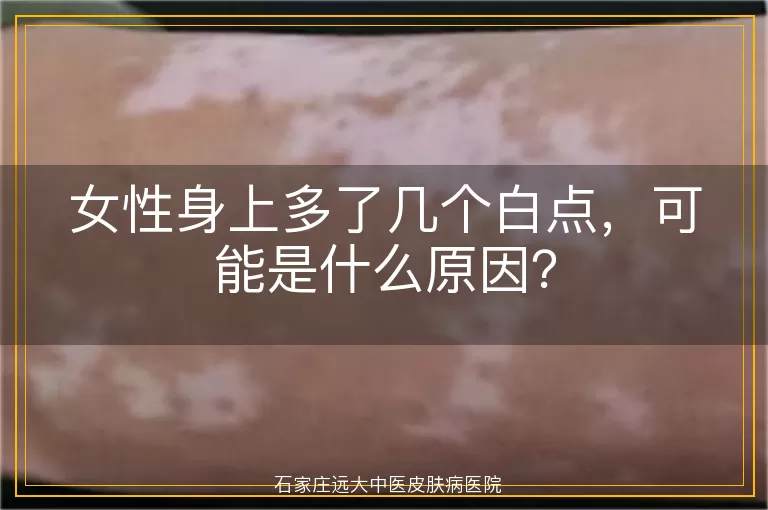 女性身上多了几个白点，可能是什么原因？