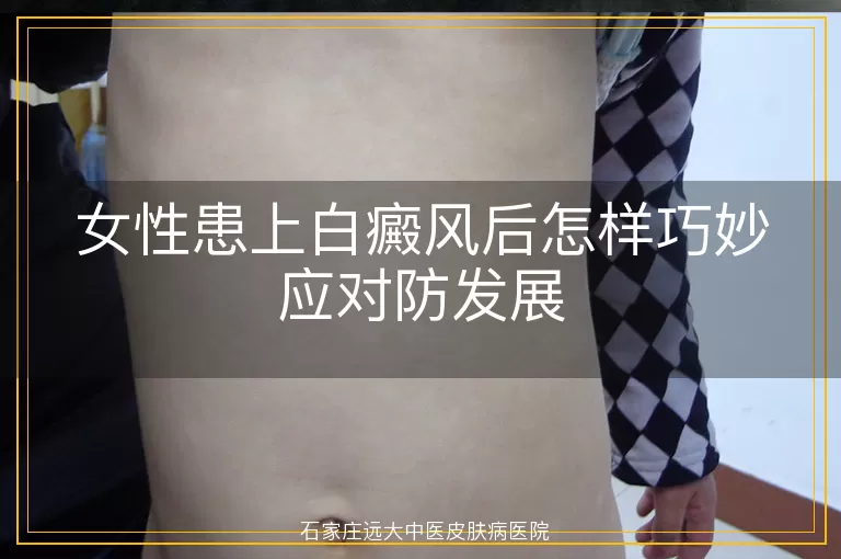 女性患上白癜风后怎样巧妙应对防发展
