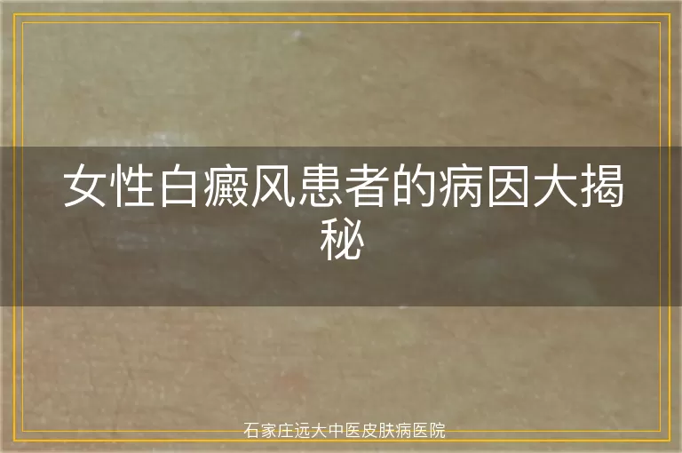 女性白癜风患者的病因大揭秘