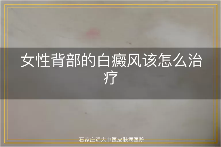女性背部的白癜风该怎么治疗