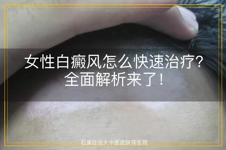 女性白癜风怎么快速治疗？全面解析来了！