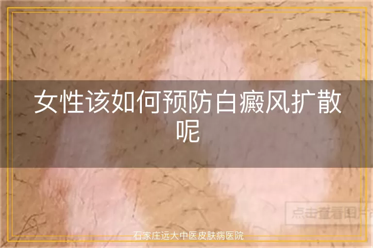 女性该如何预防白癜风扩散呢