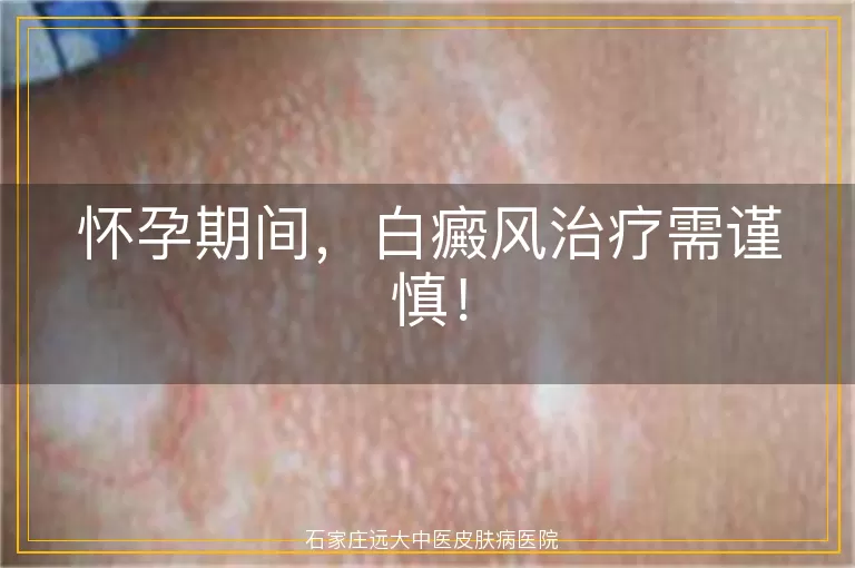 怀孕期间，白癜风治疗需谨慎！
