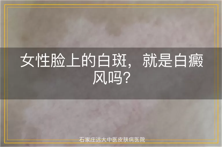 女性脸上的白斑，就是白癜风吗？