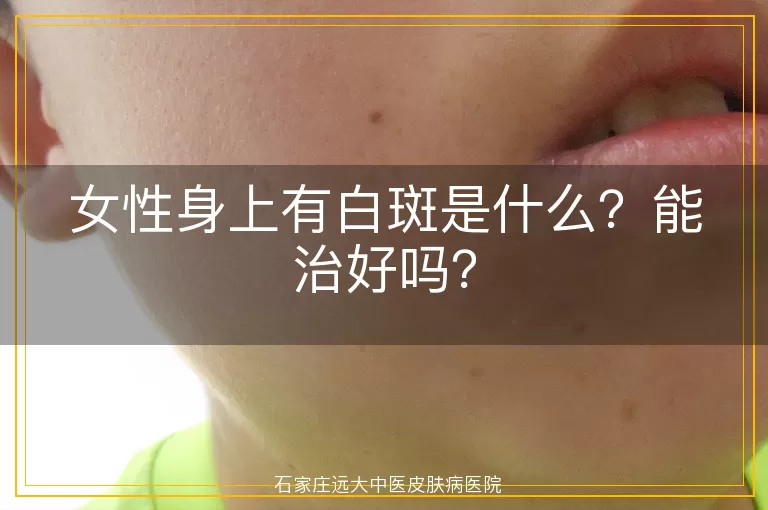 女性身上有白斑是什么？能治好吗？