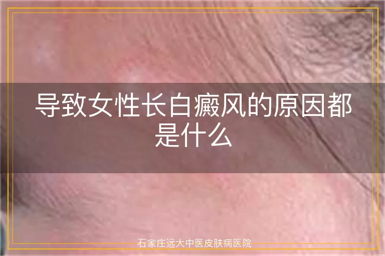 导致女性长白癜风的原因都是什么