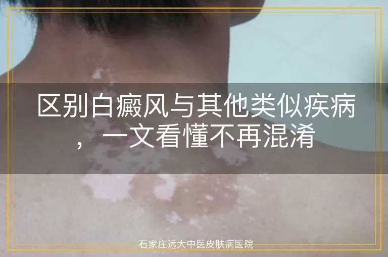 区别白癜风与其他类似疾病,一文看懂不再混淆