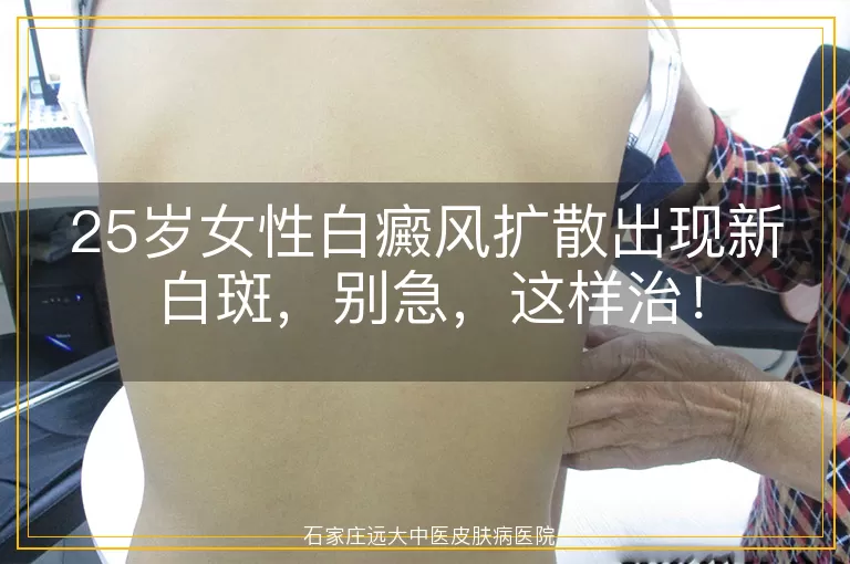 25岁女性白癜风扩散出现新白斑，别急，这样治！