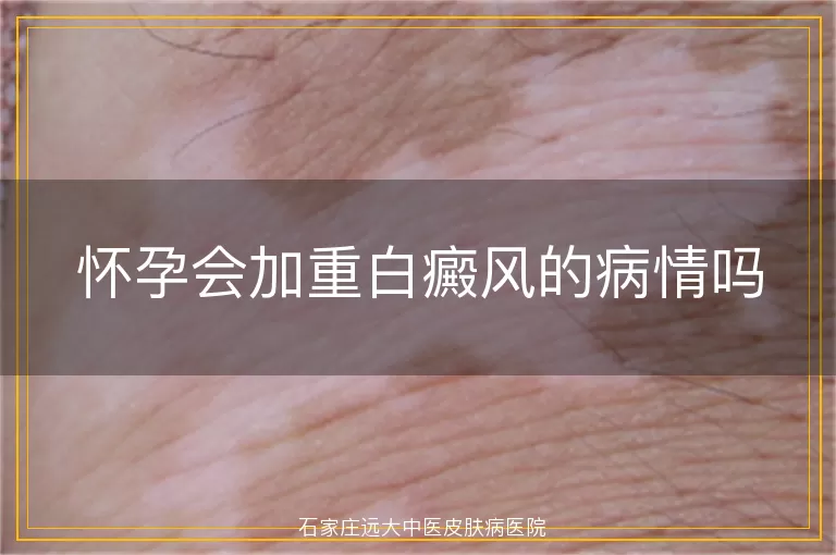 怀孕会加重白癜风的病情吗