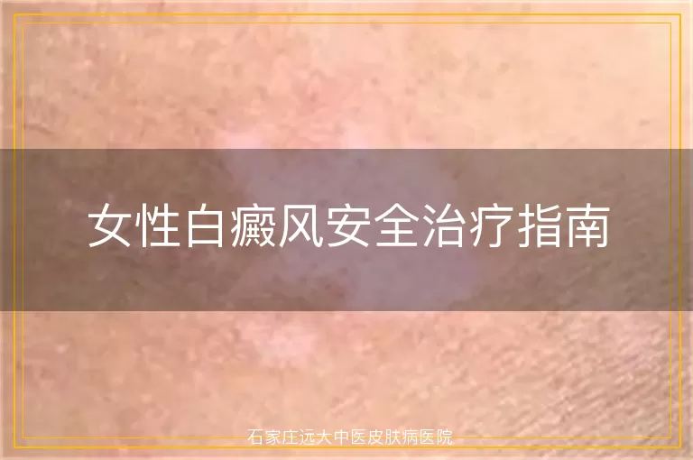 女性白癜风安全治疗指南