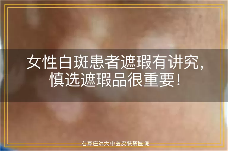 女性白斑患者遮瑕有讲究，慎选遮瑕品很重要！