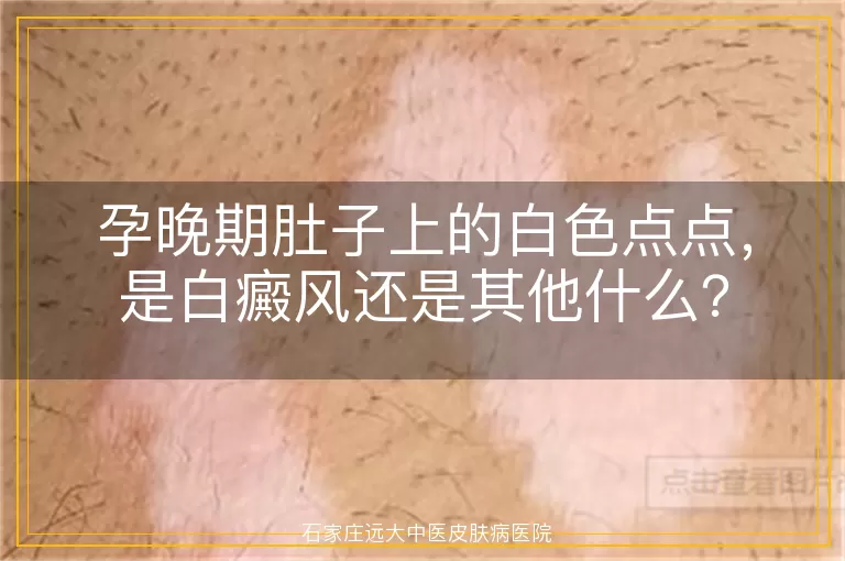 孕晚期肚子上的白色点点，是白癜风还是其他什么？