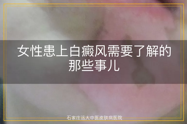 女性患上白癜风需要了解的那些事儿