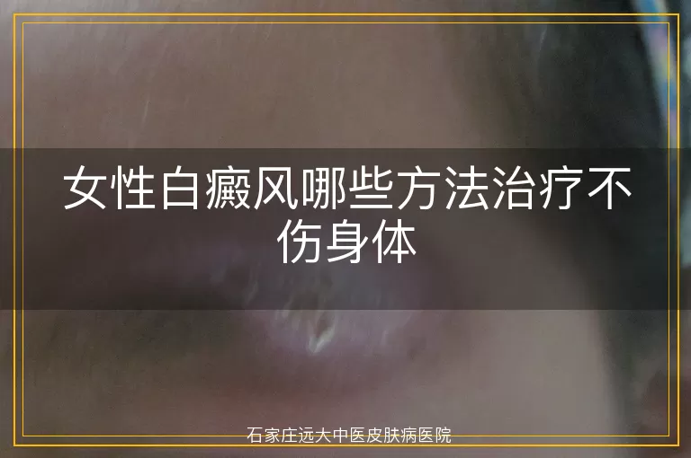 女性白癜风哪些方法治疗不伤身体