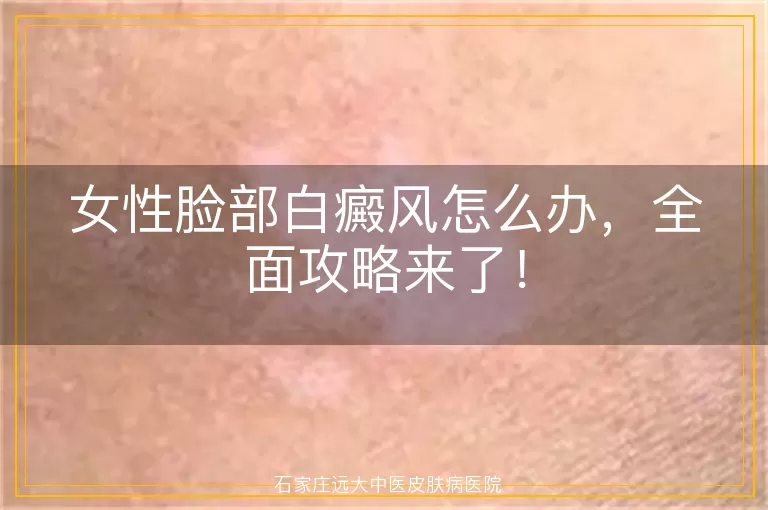 女性脸部白癜风怎么办，全面攻略来了！