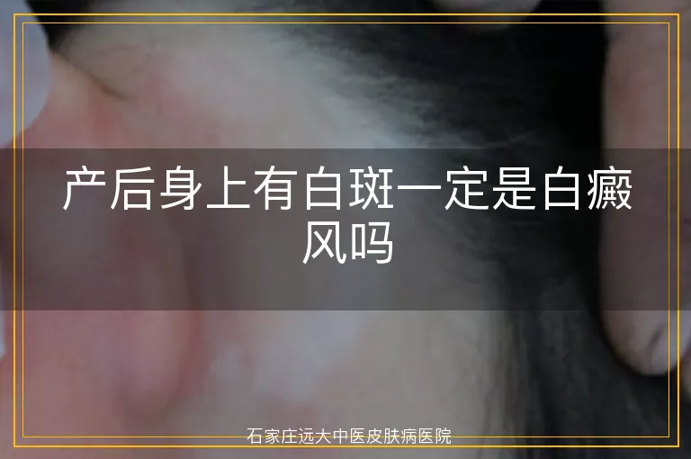产后身上有白斑一定是白癜风吗