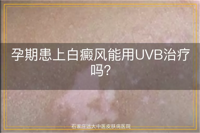 孕期患上白癜风能用UVB治疗吗？
