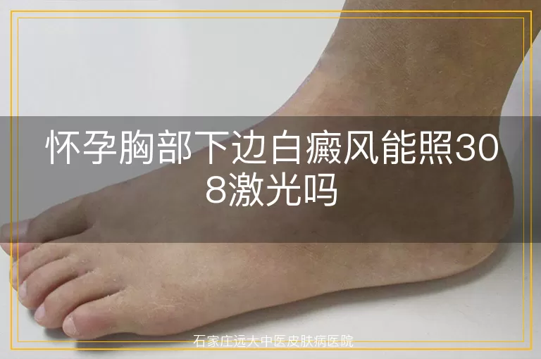 怀孕胸部下边白癜风能照308激光吗