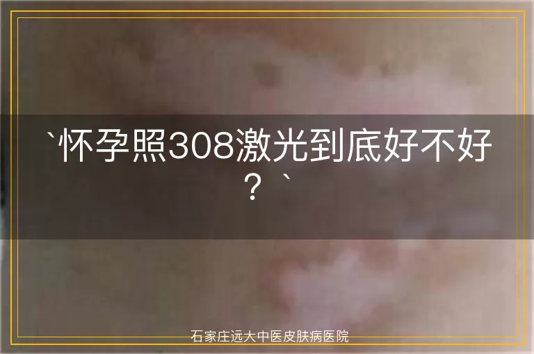 怀孕照308激光到底好不好？