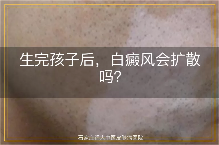 生完孩子后，白癜风会扩散吗？