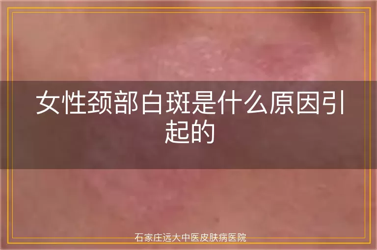 女性颈部白斑是什么原因引起的