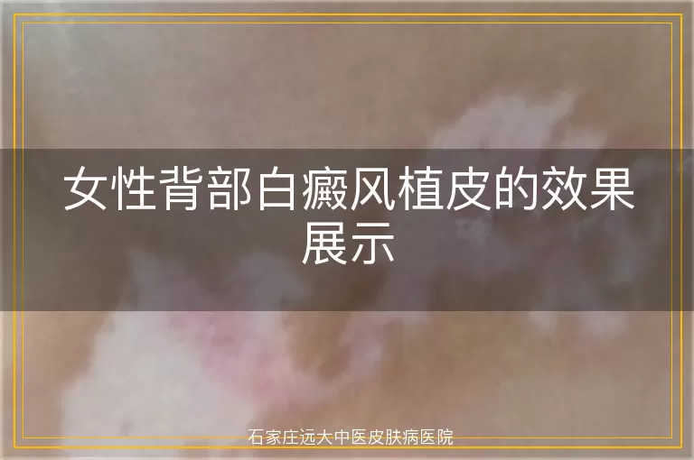 女性背部白癜风植皮的效果展示