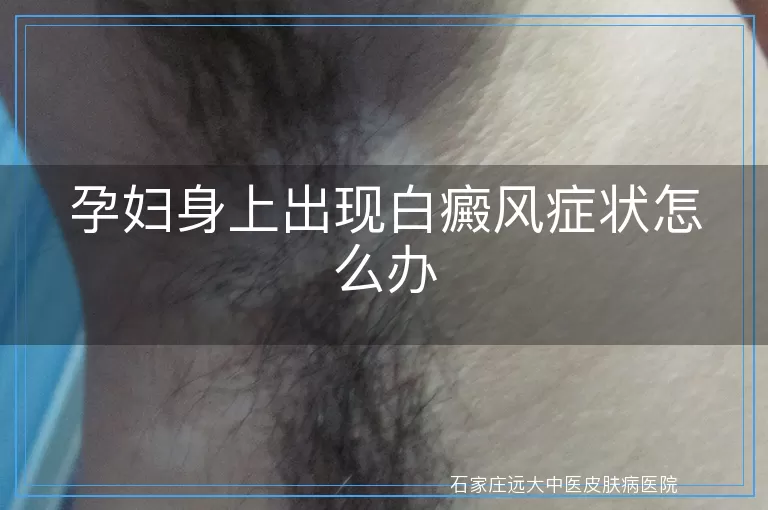 孕妇身上出现白癜风症状怎么办