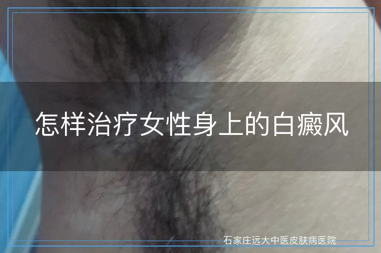 怎样治疗女性身上的白癜风