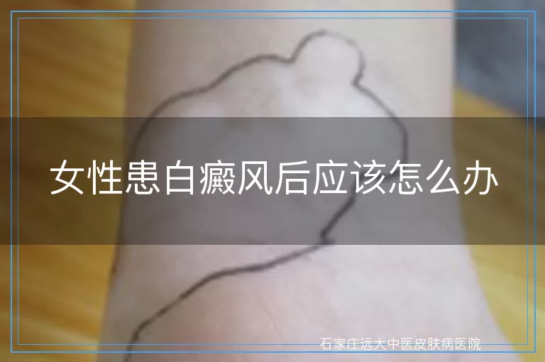 女性患白癜风后应该怎么办