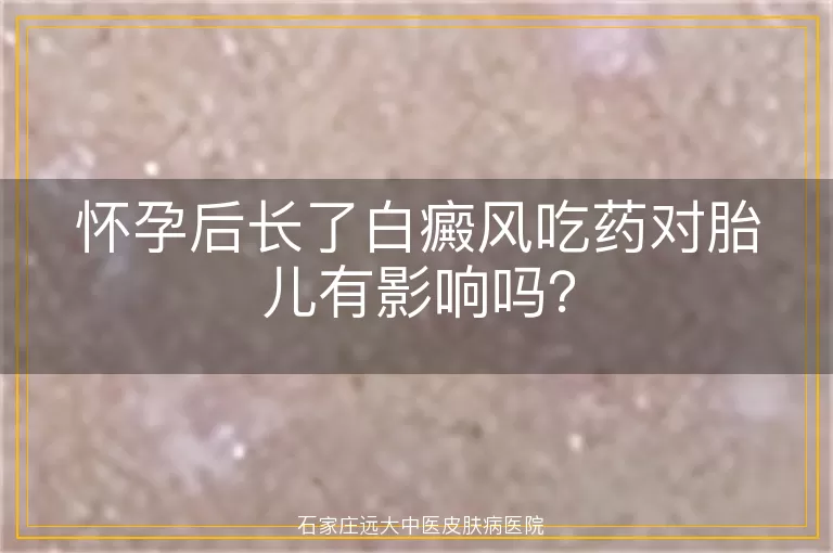 怀孕后长了白癜风吃药对胎儿有影响吗?