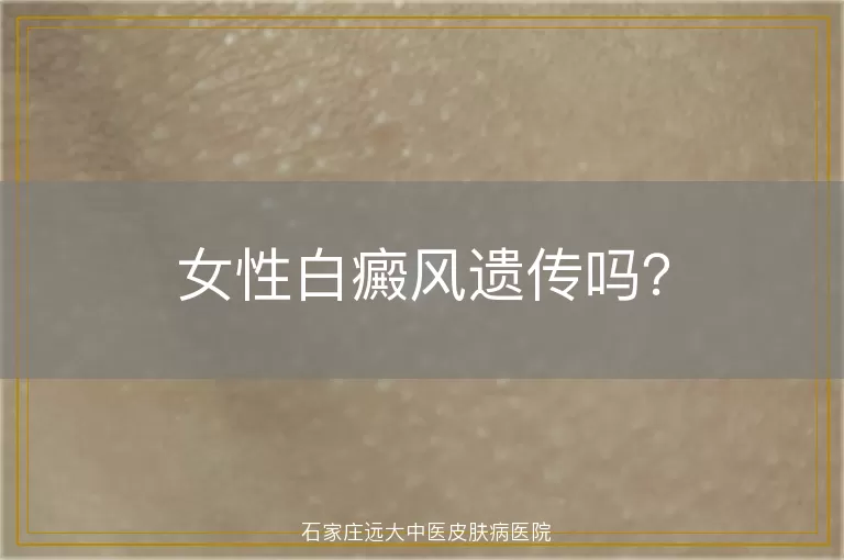 女性白癜风遗传吗？